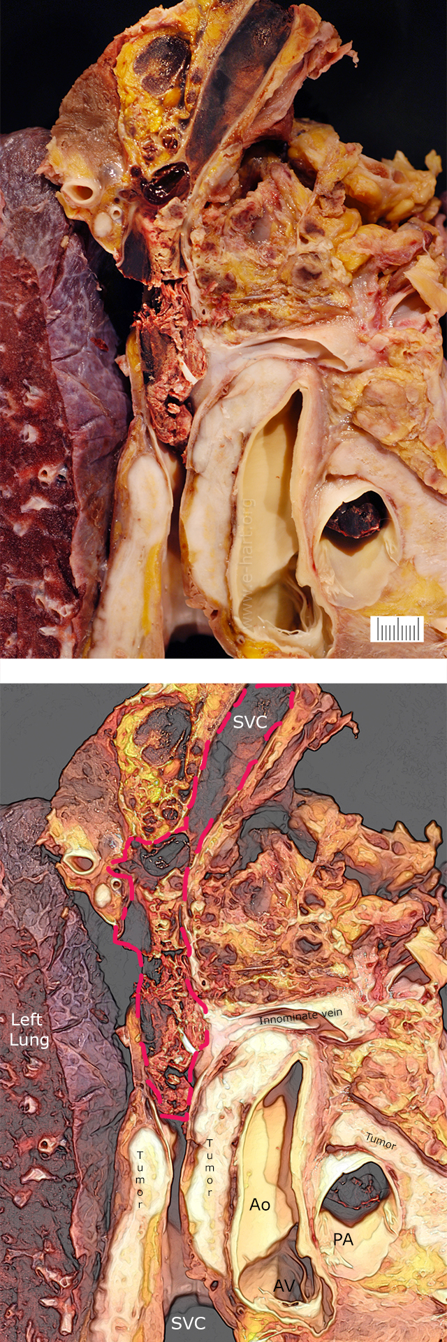 Pericardial mesothelioma with thormbosed superior vena cava gross